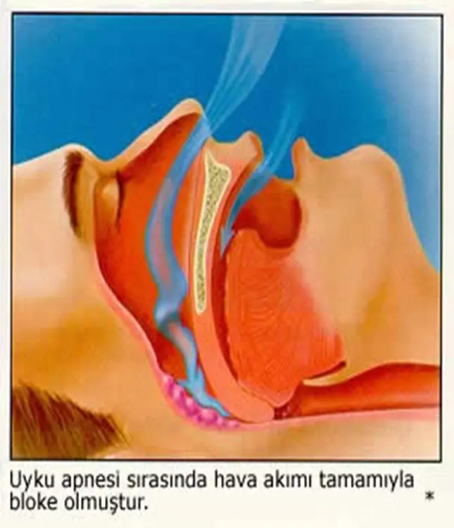 Uyku Apnesi Örneği
